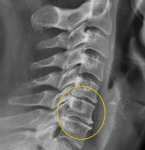 Gebärmutteral Osteochondros